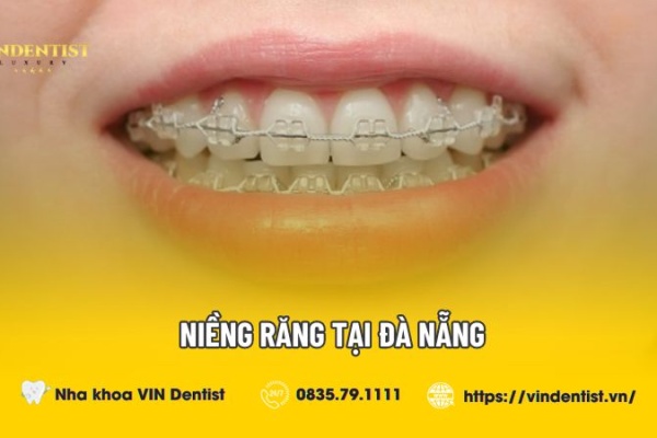 giá niềng răng tại Đà Nẵng